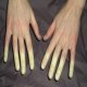 Raynaud's Phenomenon