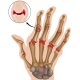 Rheumatoid arthritis