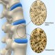 Osteoporosis