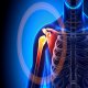Shoulder Pain