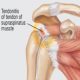 Tendonitis