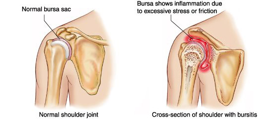 Polymyalgia Rheumatica